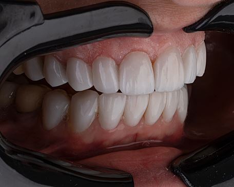 Стоматолог Лукьянченко предупредила, что зубочистки могут принести больше вреда, чем пользы